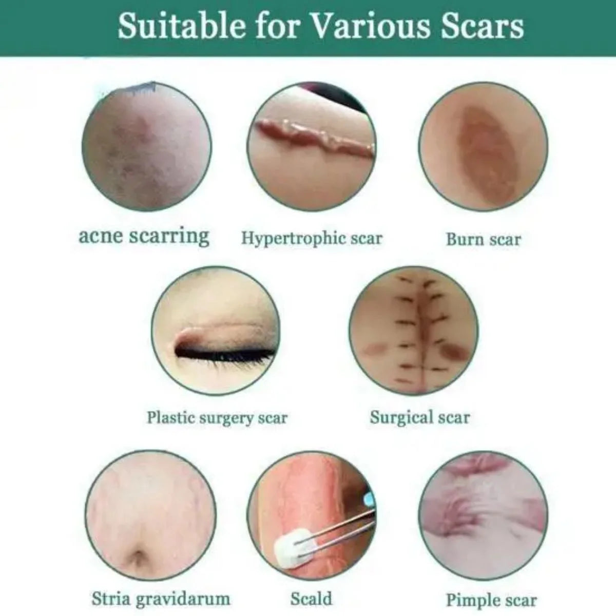 Jaysuing Fade Scar Cream Gel Skin Scar Repair Cream Postpartum Stretch Mark Scar Surgery Smooths Skin Oasis Select