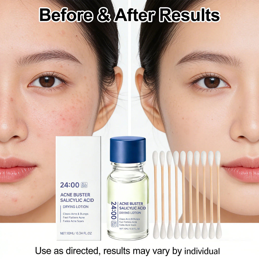 Salicylic Acid Drying Lotion Face Serum with Cotton Swab– Reduce Pimples & Breakouts Fade Acne Scars Minimize Pores Skin Renewal Oasis Select