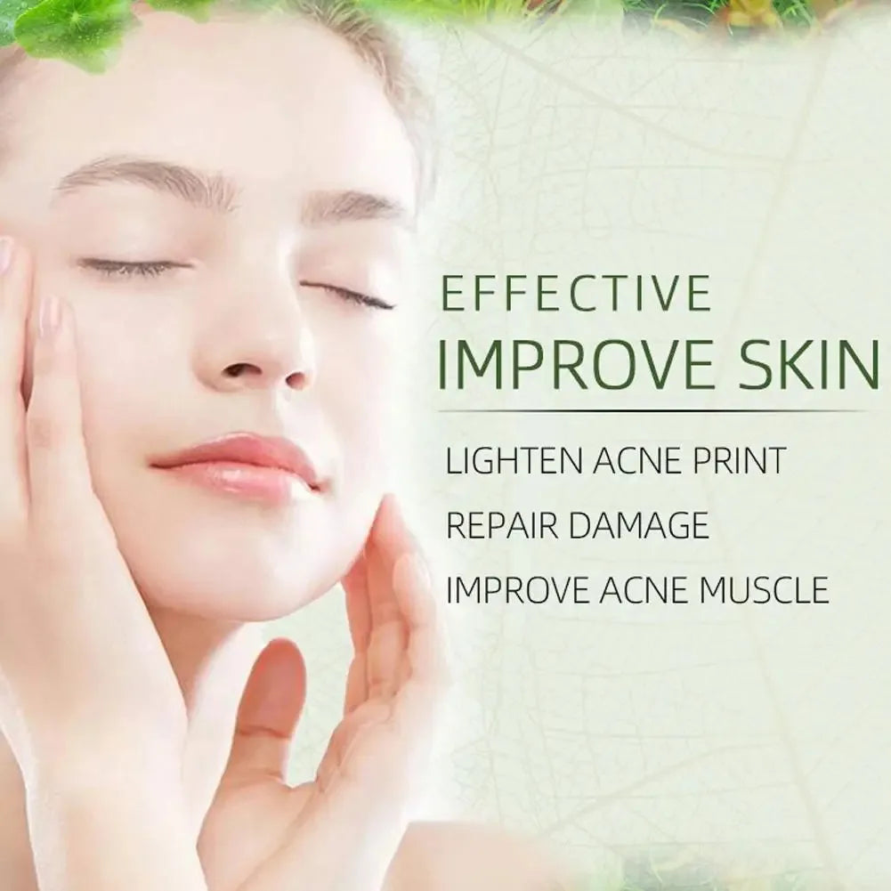 JoyPretty Herbal Acne Face Cream – Oil Control & Marks Removal Herbal Acne Cream Oasis Select