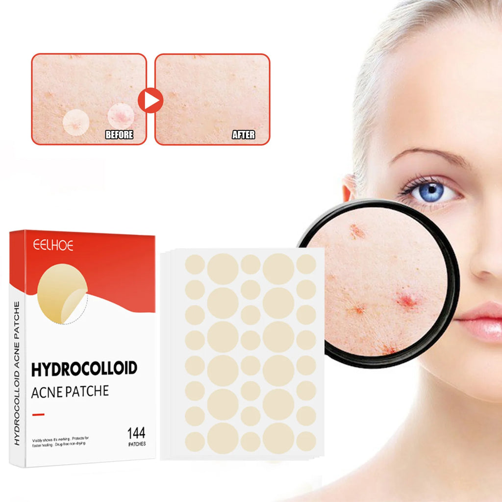 144pcs/set Face Skin Care Acne Pimple Patch 2 Sizes Invisible Professional Healing Absorbing Spot Sticker Covering for Men Women Oasis Select