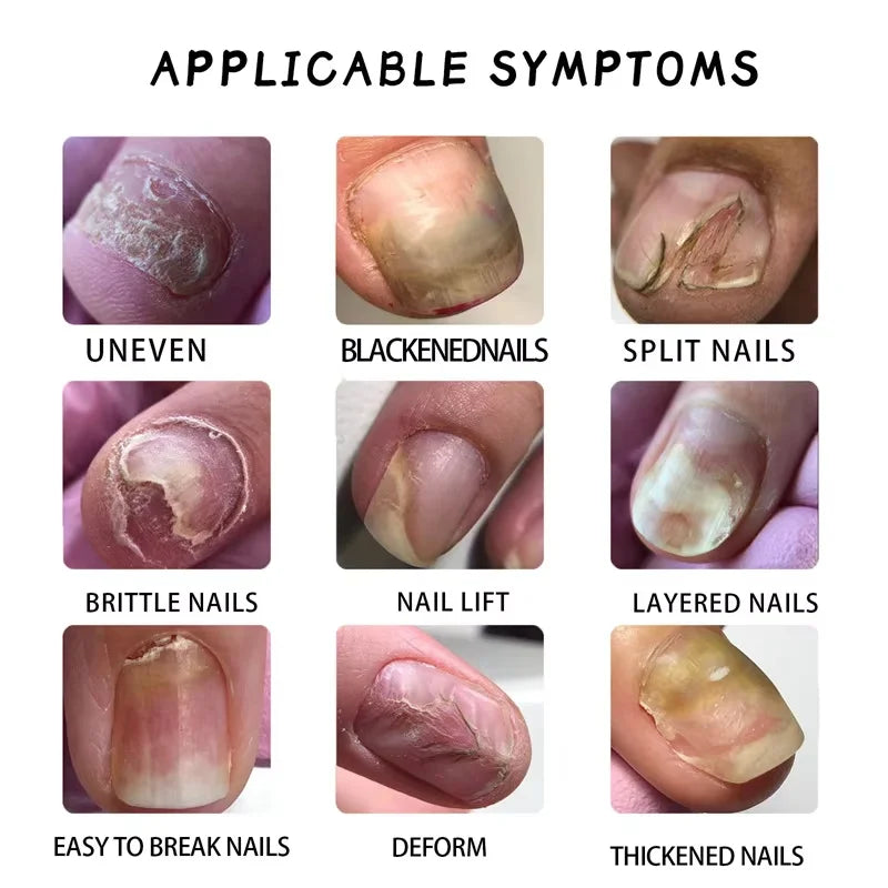 Ginger Nail Repair Serum – Restore Discolored & Uneven Nails Nail Treatment Serum Oasis Select