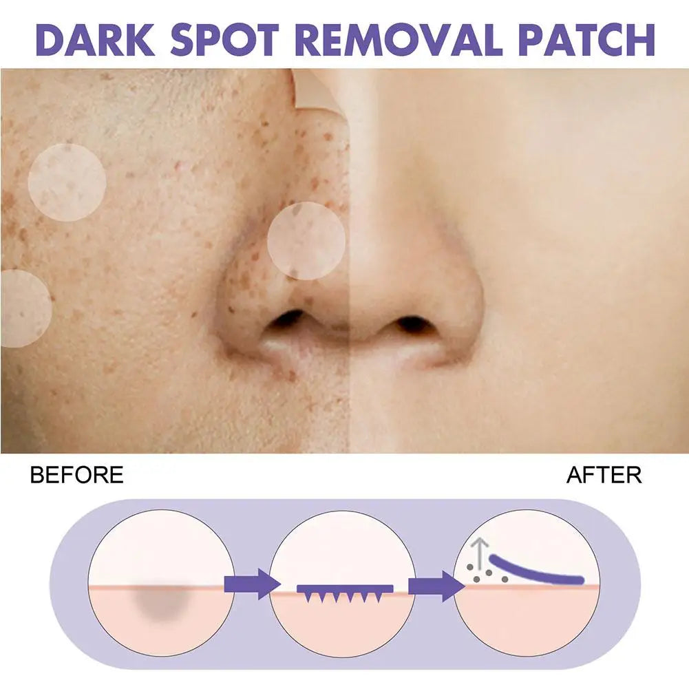 Eelhoe Invisible Acne Spot Patches – 144pc Pimple Cover