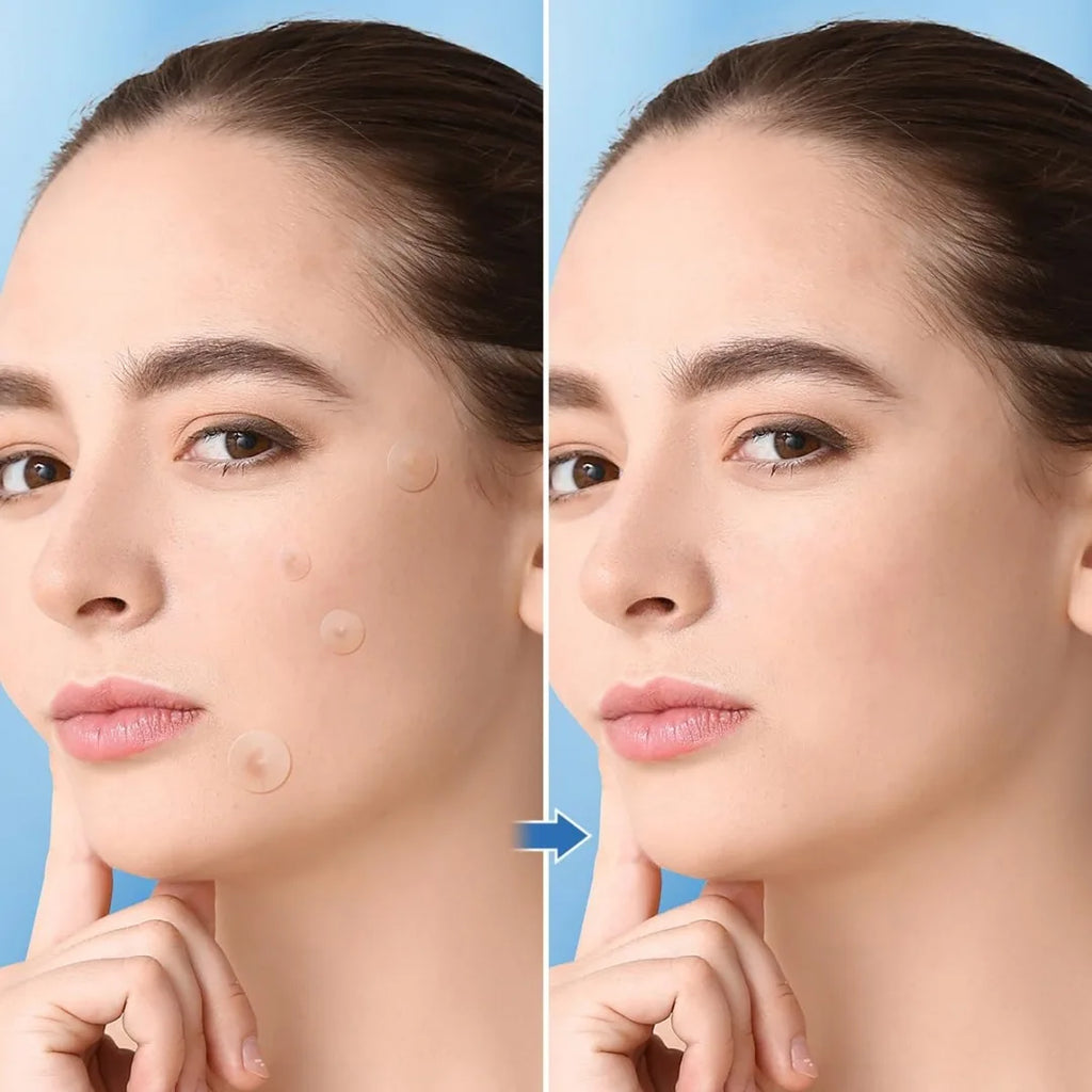1200 PCS Transparent Acne Patches, Gentle and Non-Irritating, Cover Acne and Pimples, Ultra-Thin, Water-Resistant Oasis Select