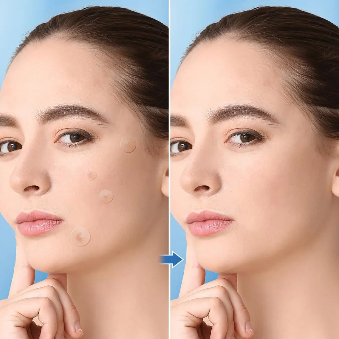 1200 PCS Transparent Acne Patches, Gentle and Non-Irritating, Cover Acne and Pimples, Ultra-Thin, Water-Resistant Oasis Select
