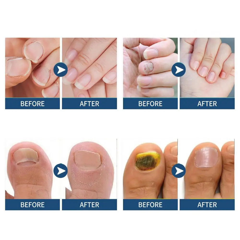 3 Packs Fungal Nail Patches, Toenail Fungus Treatment Extra Strength – Overnight Nail Care Repair For Damaged Discolored Nails Oasis Select