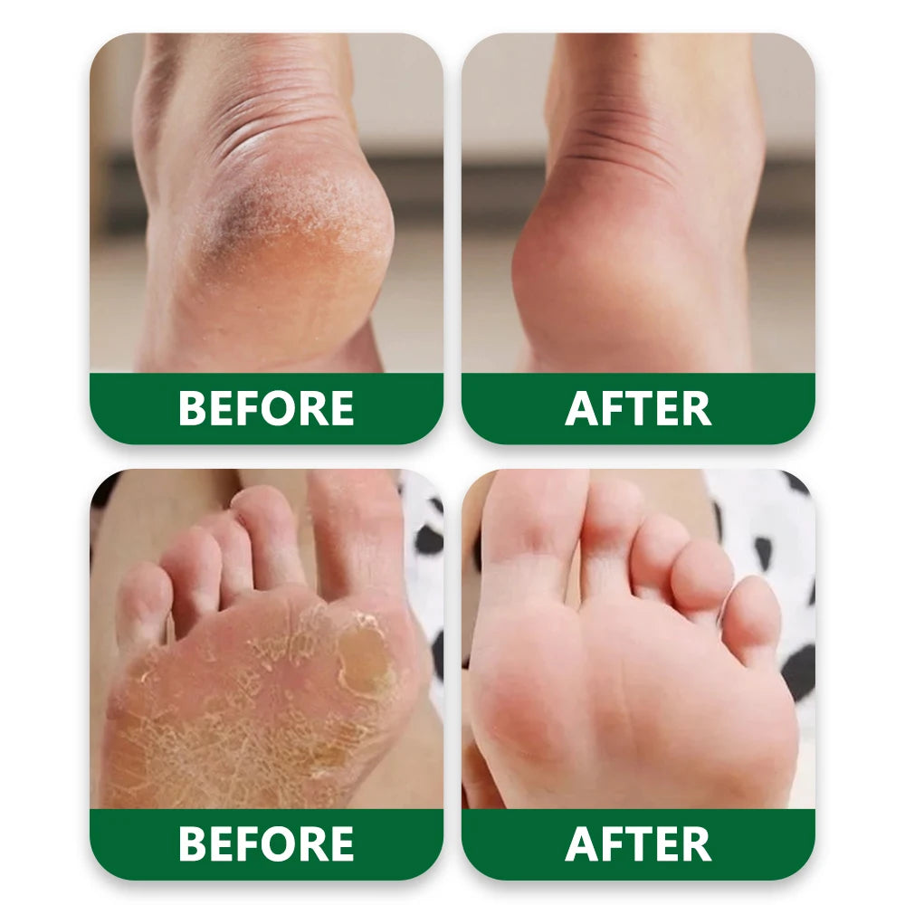 Tea Tree Oil Foot Cream, Warming Cream - Calluses, Dry Cracked Feet, Hands, Heels, Elbow -Softens & Moisturizes Skin, Foot Balm Oasis Select
