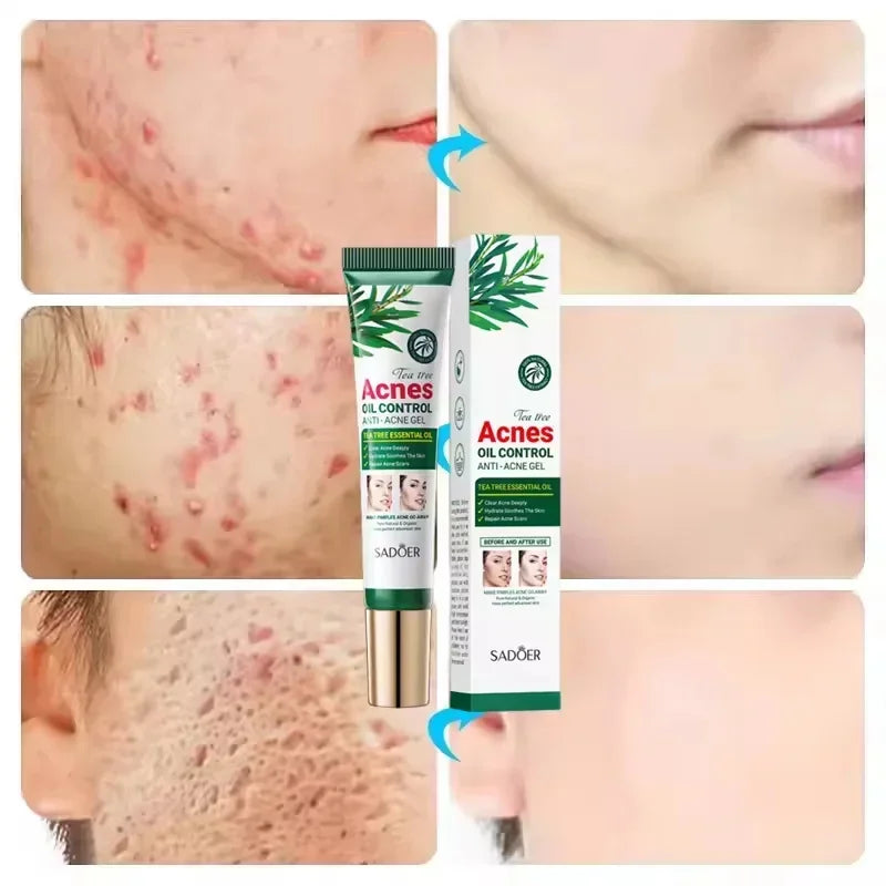 Tea Tree Facial Gel Cream – Oil Control & Blemish Care