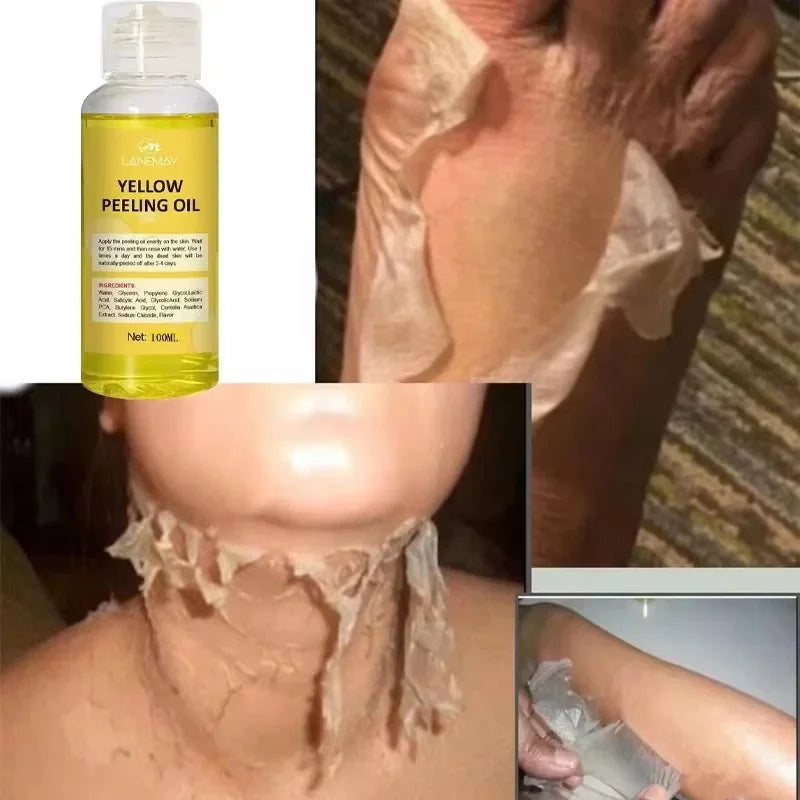 Strong Yellow Peeling Oil Bleach Dark Skin Whiten Lotion Lighten Body Elbow Knee Hand Exfoliate Dead Skin Nourish Even Skin Tone Oasis Select