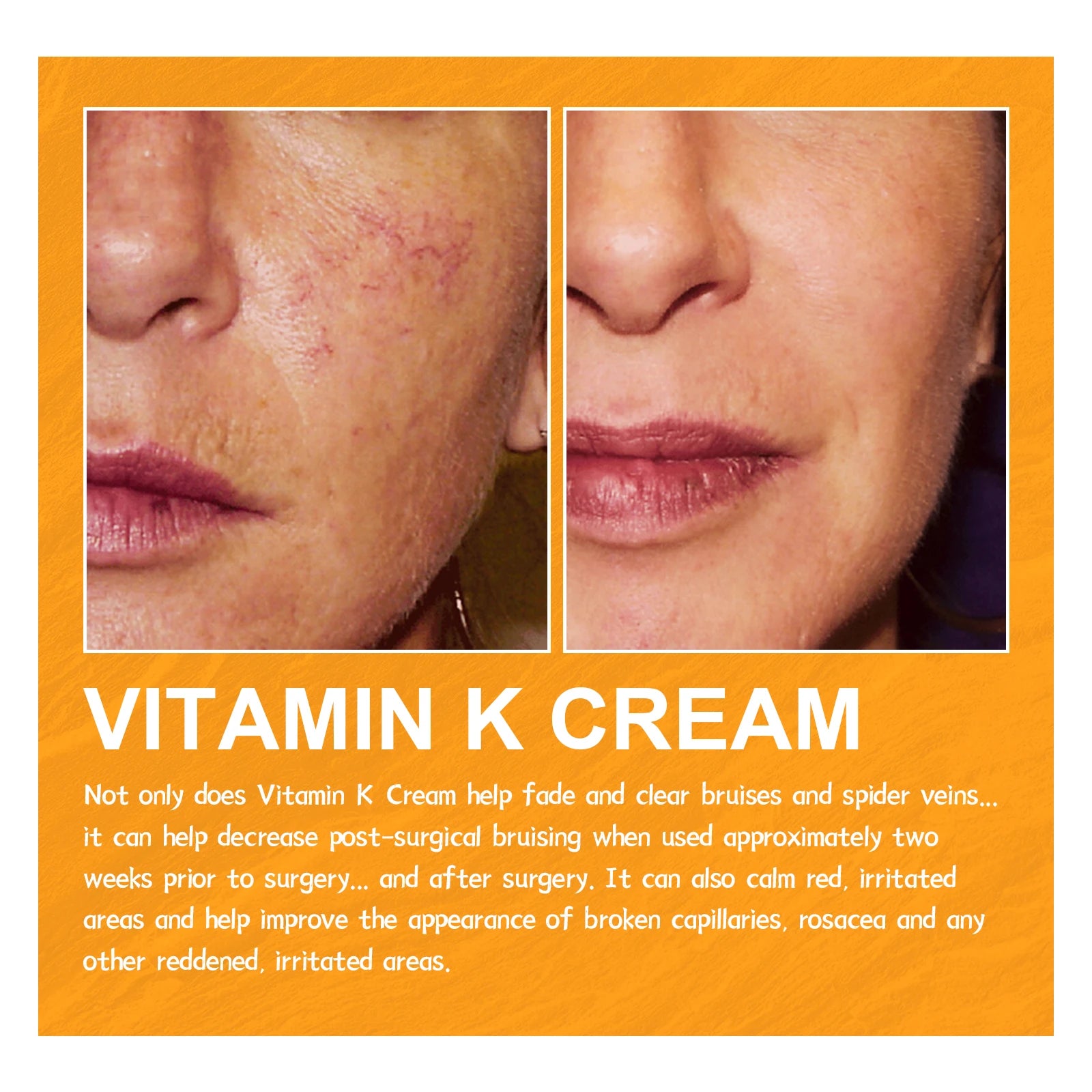 Vitamin K Cream Effective Varicose Vein Relief Cream Massage Care Relieve Leg Soreness Swelling Phlebitis Spider Pain Ointment Oasis Select