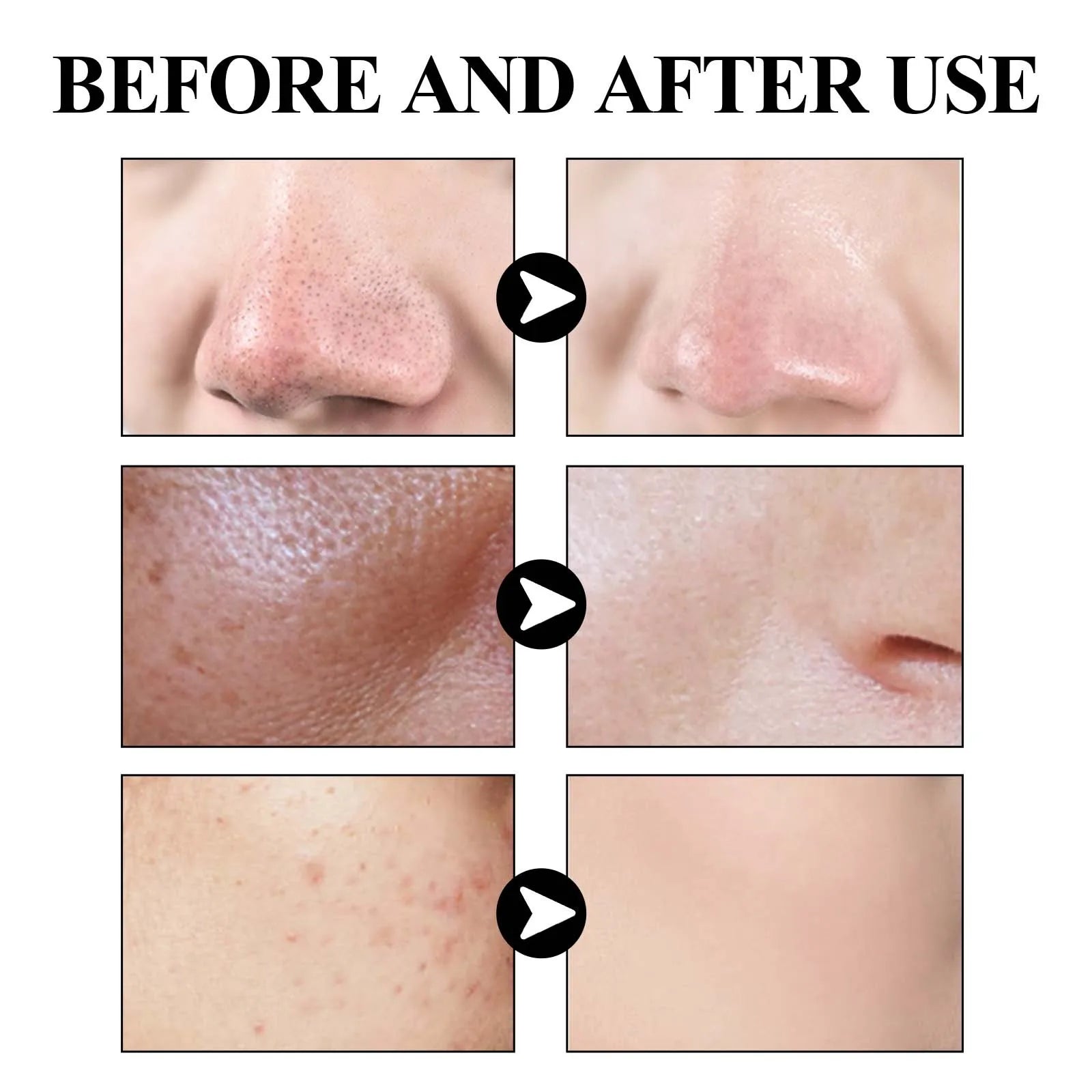 40g 4 pcs Blackhead Cleansing Mud Film, Dilute Acne and Acne Marks, Tighten Pores, Deeply Clean and Moisturize The Skin Oasis Select