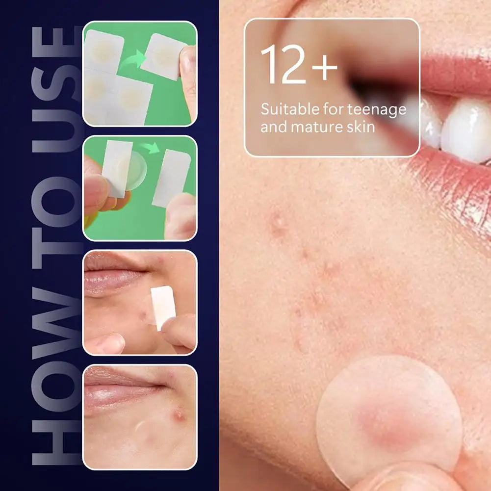 12/24pcs Acne Microneedle Patches For Overnight Use,Hydrocolloid Technology Dissolves Blemishes, Invisible Skin Care 0.2mm Oasis Select