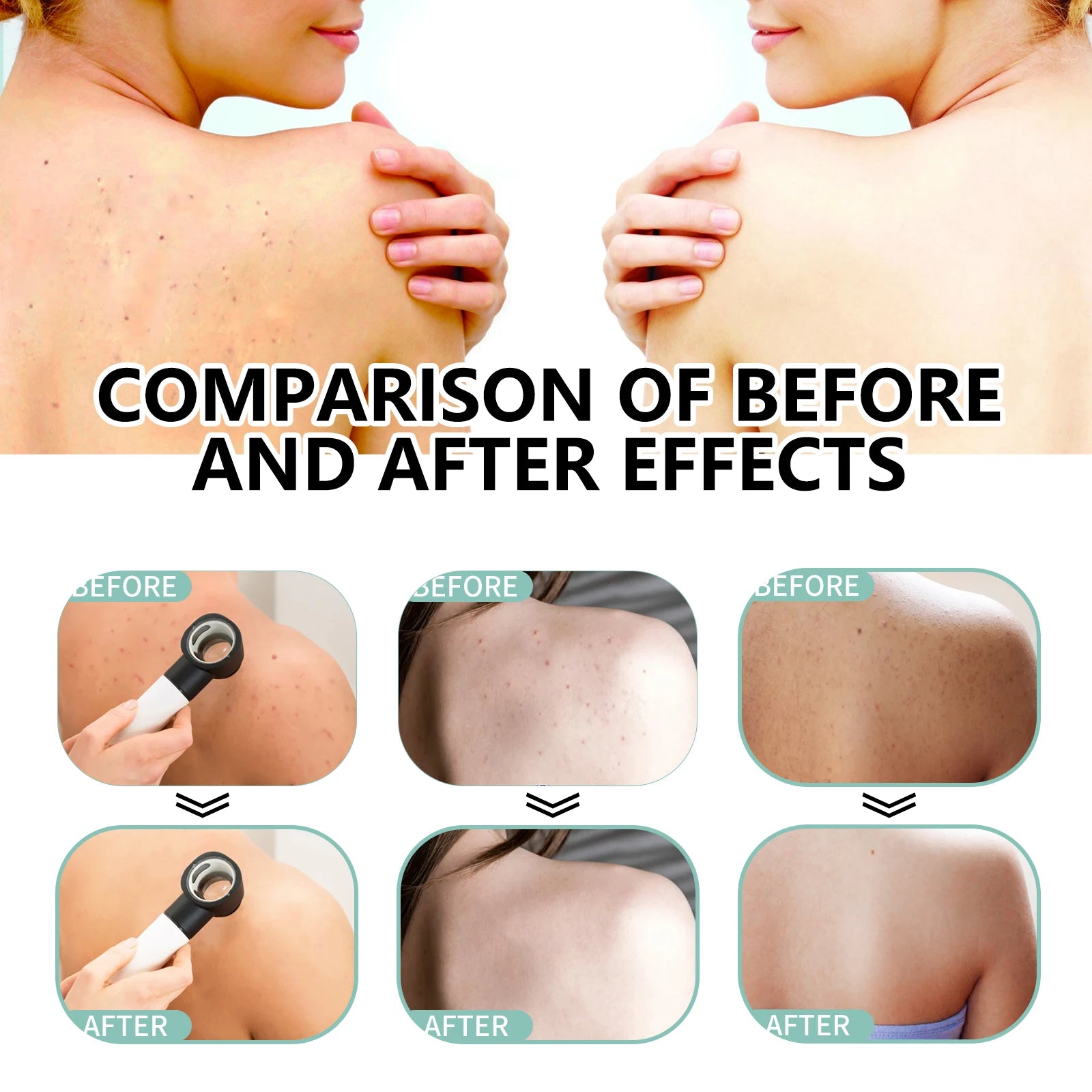 Herbal Acne Remover Spray Back Shoulder Pimple Treatment Blackhead Anti Mites Oil Control Repair Smooth Skin Care Beauty Health Oasis Select