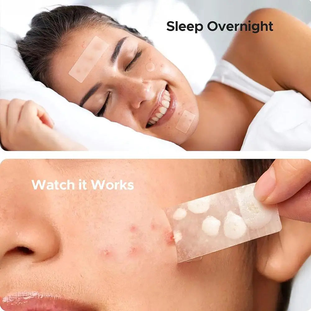 Mixed Sizes Hydrocolloid Pimple Patches Large Hydrocolloid Pimple Patches Invisible Acne Circle Stickers for Zits, Spots, Pimple Oasis Select
