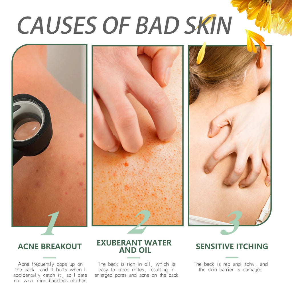 Keratosis Pilaris Repair Cream – Smooth Bumpy Chicken Skin Body Repair Cream Oasis Select