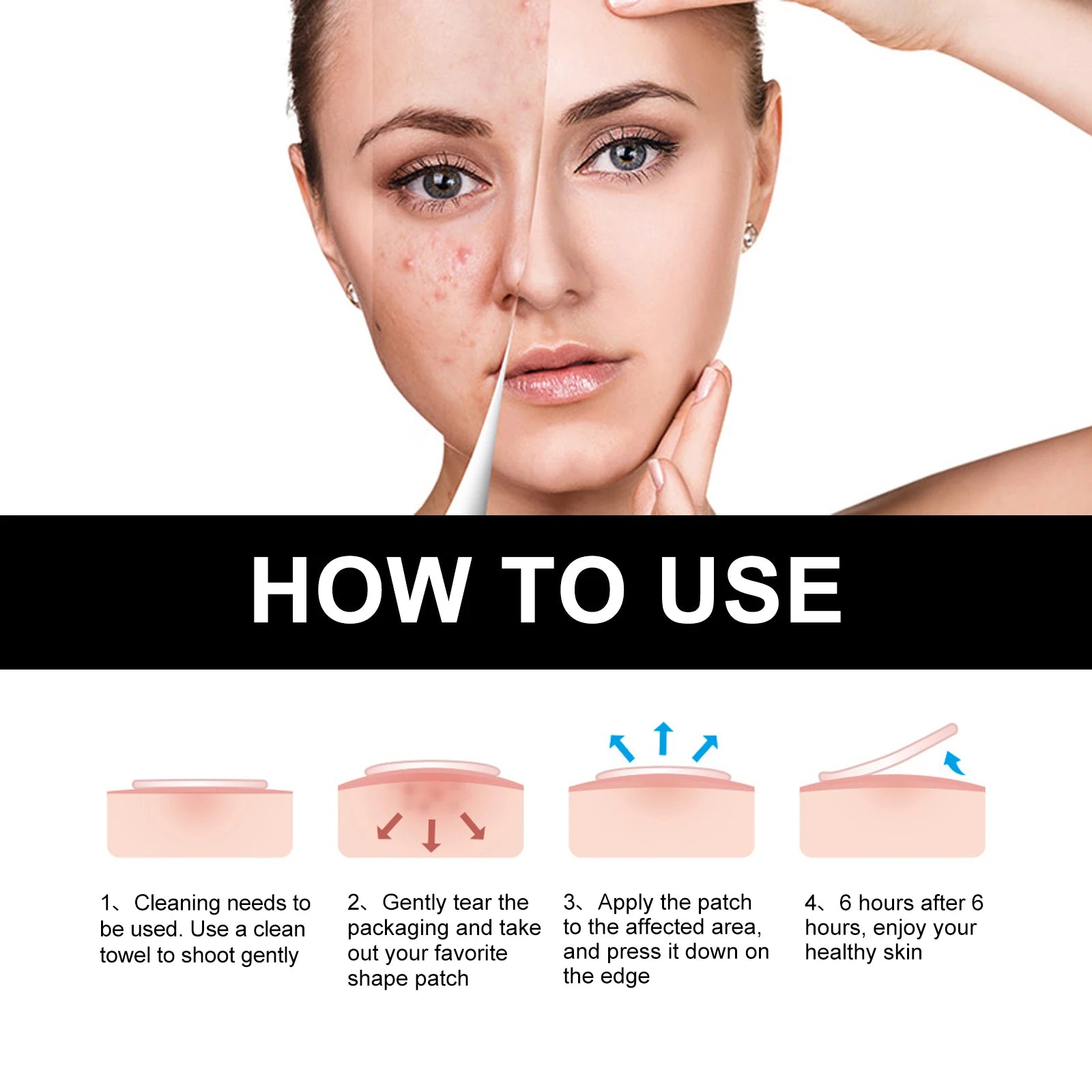Hoygi Black Acne Patches – Spots, Blackheads & Blemish Care