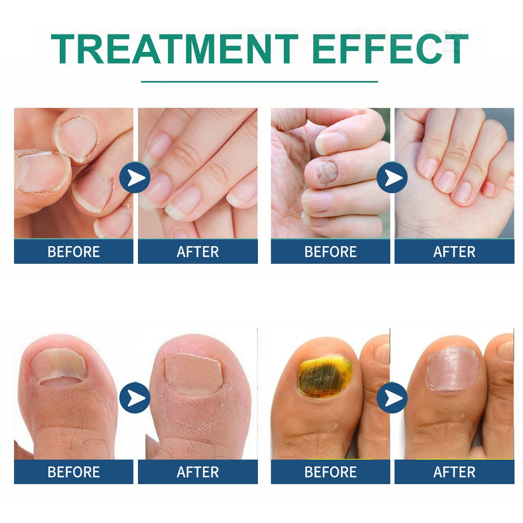32-Piece Ingrown Toenail Correction Patches & Nail Repair Stickers