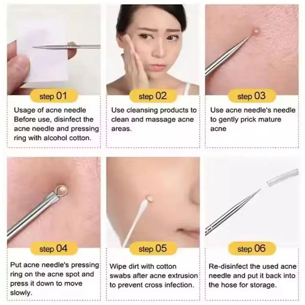 4-Piece Blackhead Remover Tool Set – Stainless Steel Pimple Popper Blackhead Remover Tool Oasis Select
