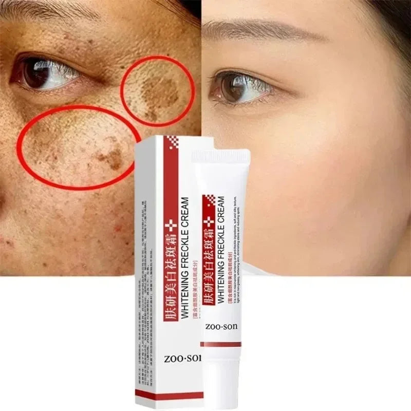 Whitening Freckle Cream Remove Dark Spots Anti Freckle Face Creams Niacinamide Fade Pigmentation Melasma Brighten Skin Care 20g Oasis Select Default Title