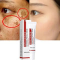 Whitening Freckle Cream Remove Dark Spots Anti Freckle Face Creams Niacinamide Fade Pigmentation Melasma Brighten Skin Care 20g Oasis Select Default Title