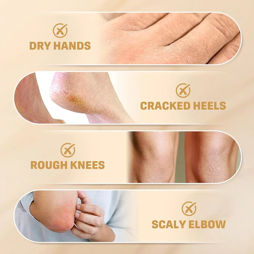Urea Cream 60g – Cracked Heels, Dry Hands & Rough Skin Repair