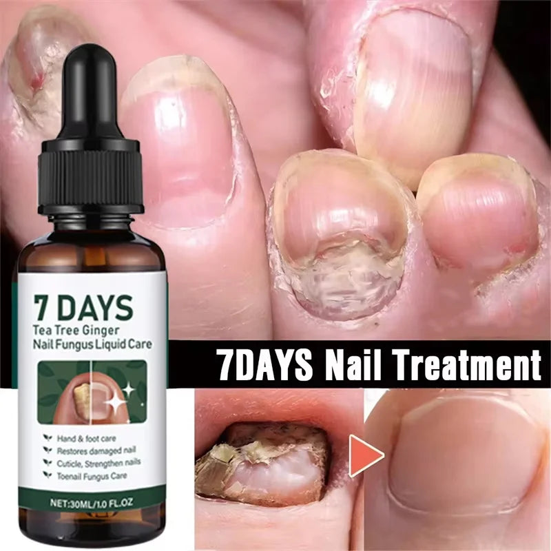 Ginger Nail Repair Serum – Restore Discolored & Uneven Nails Nail Treatment Serum Oasis Select