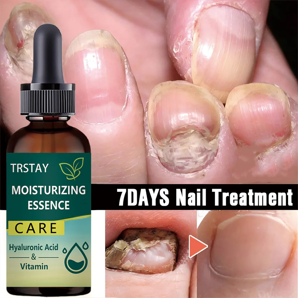 7DAYS Repair Nail Fungus Treatments Essence Foot Care Serum Toe Nails Fungal Removal Gel Anti-Infection Oasis Select 15ml