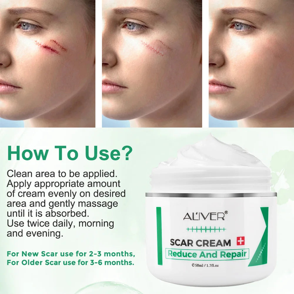 ALVER Acne Scar Stretch Marks Remover Cream Skin Repair Acne Black Dots Spots Acne Treatment Blackhead Bleaching Cream 50ml Oasis Select