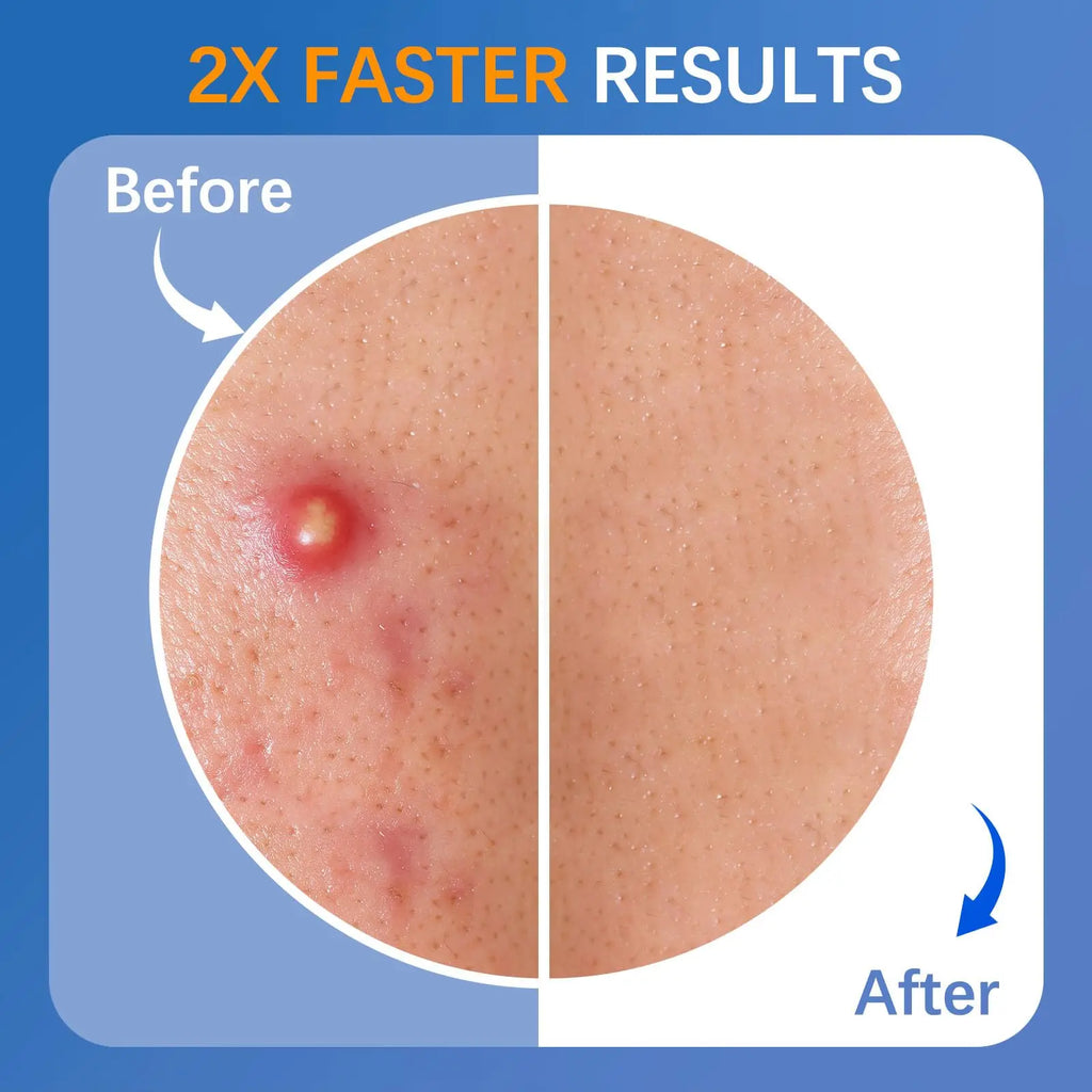 Hyaluronic Acid Microneedle Acne Patch – Invisible & Breathable