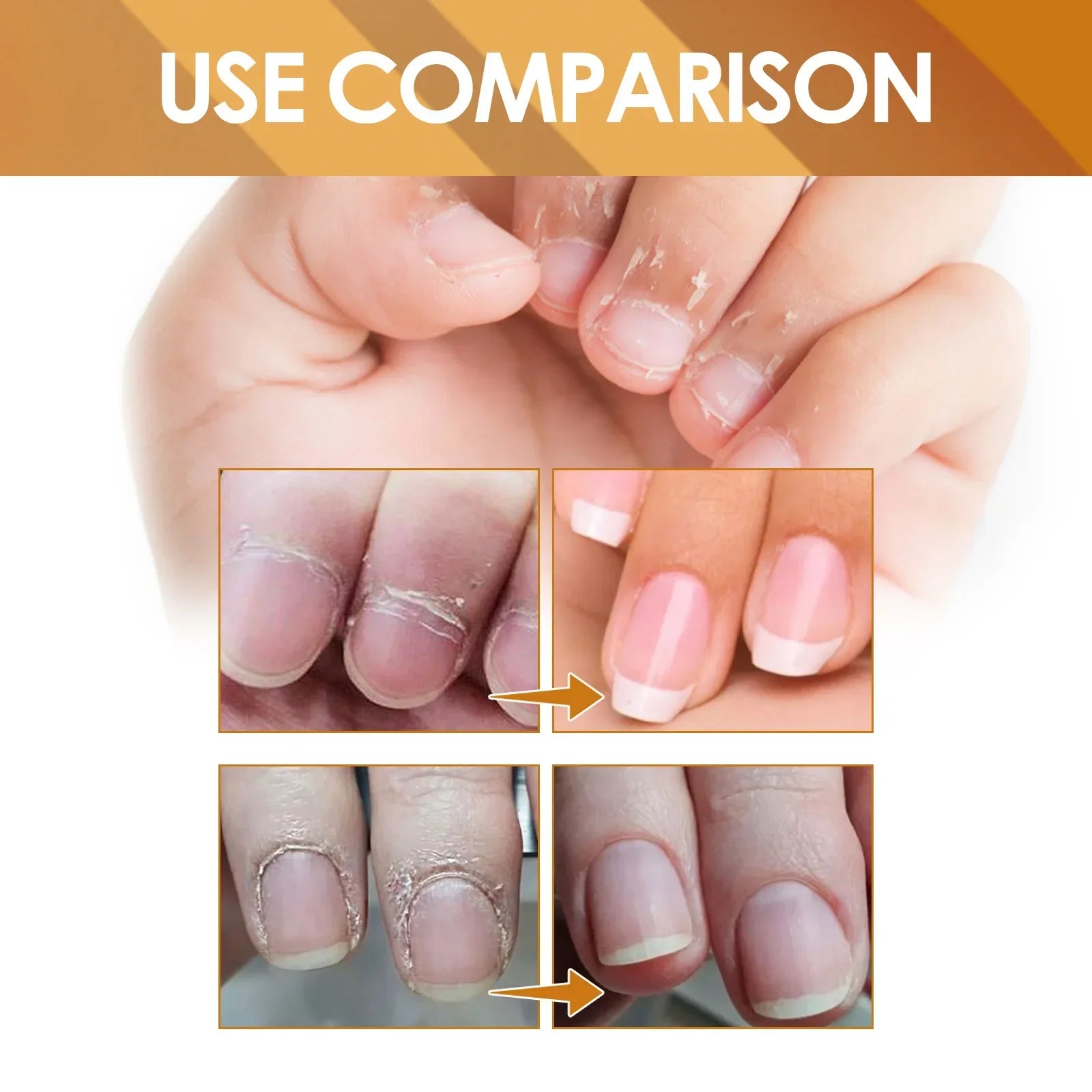 EELHOE Cuticle Removal Gel – Nail Softener & Dead Skin Remover Cuticle Removal Gel Oasis Select