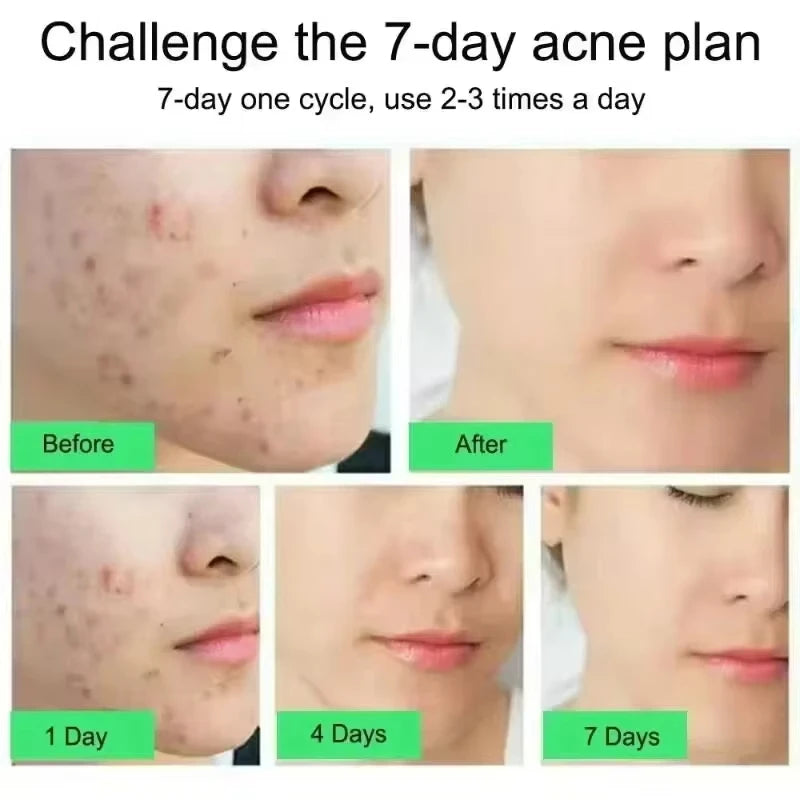 SADOER Salicylic Acid Acne Cream – Oil Control & Pore Minimizer Acne Face Cream Oasis Select