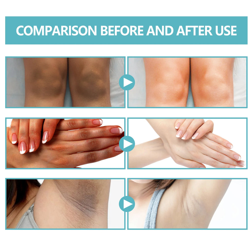 EELHOE Whitening Cream Brightening Skin For Dark Skin Neck Arm Knee Joint Underarm Body Care Acanthosis Nigricans Therapy Cream Oasis Select