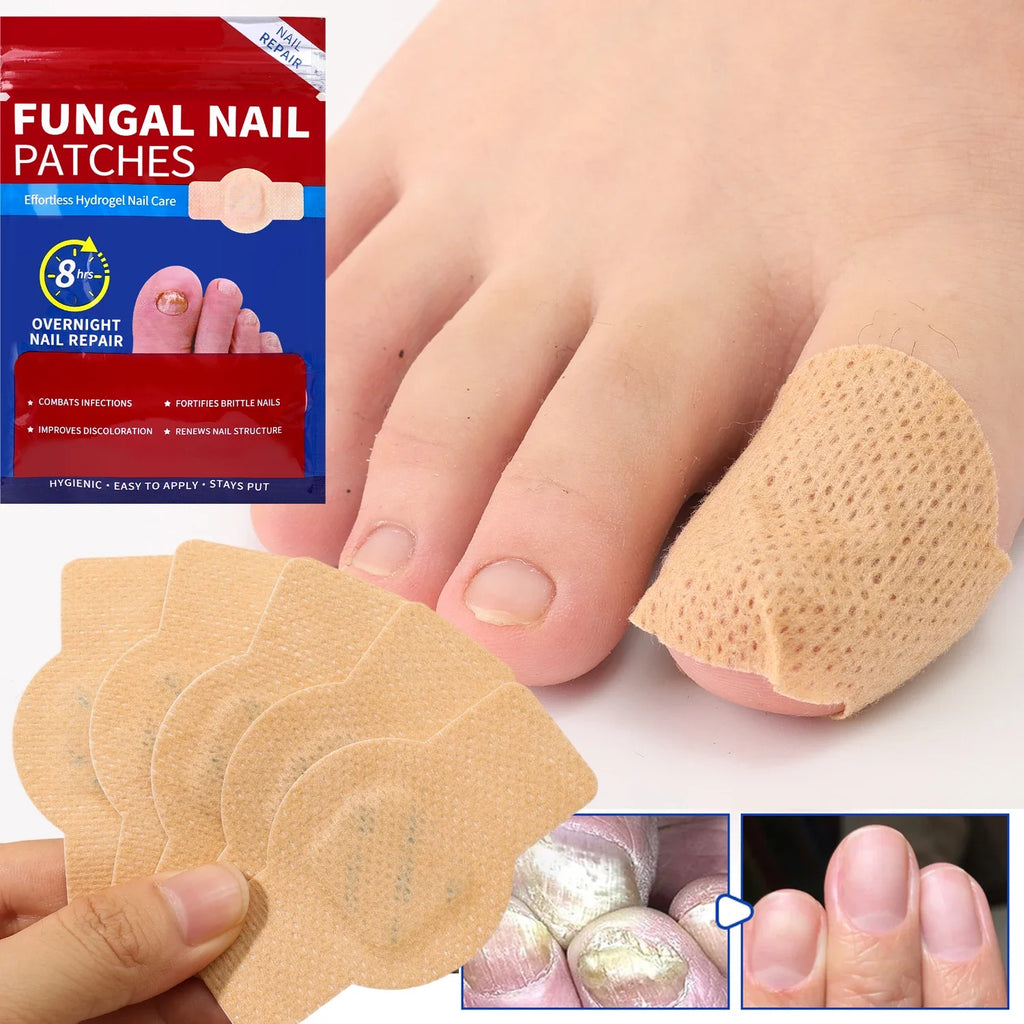 Nail Repair Patches – Toenail Care & Ingrown Correction Stickers Nail Care Patch Oasis Select