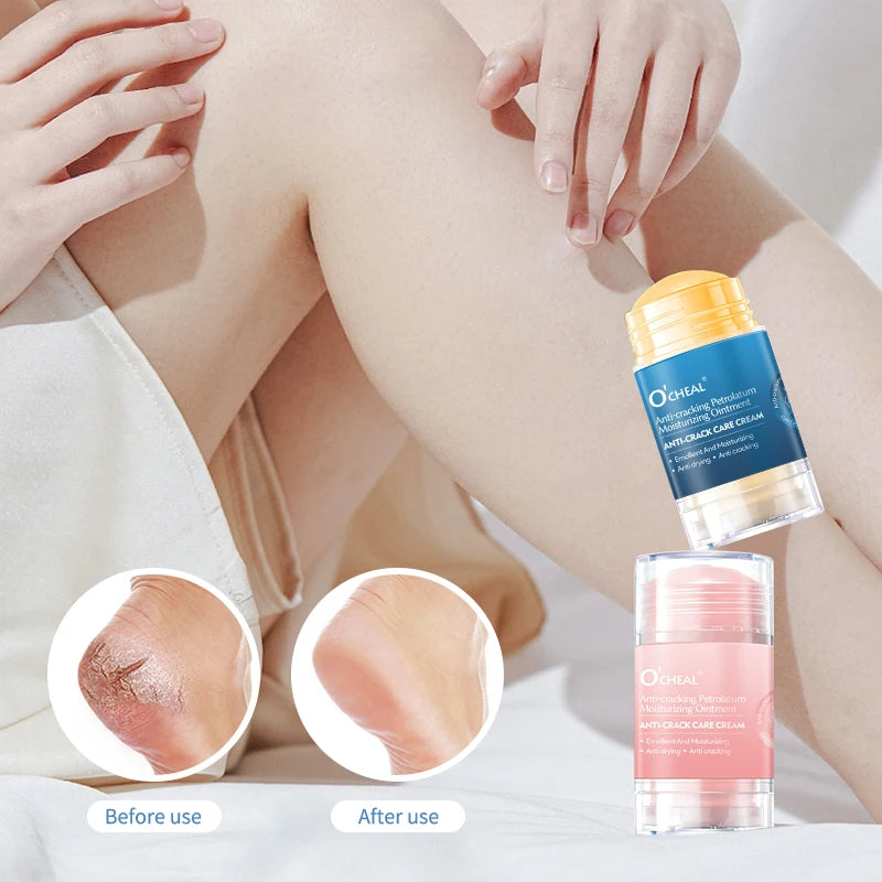 Anti-Crack Foot Cream for Dry & Cracked Heels – Moisturizer Foot Cream Oasis Select